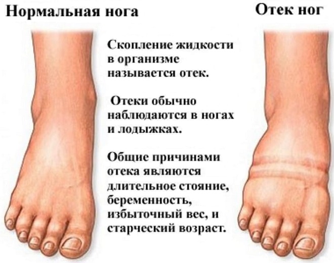 сравнение нормальной ноги с отечной