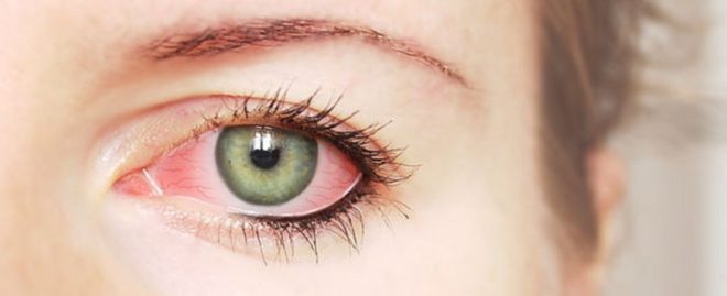 глазное кровоизлияние