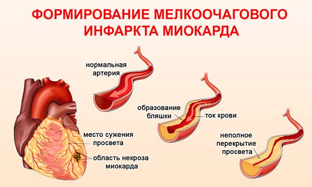 Мелкоочаговый инфаркт миокарда