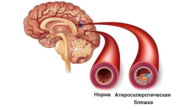 Атероматозная бляшка в артериях мозга