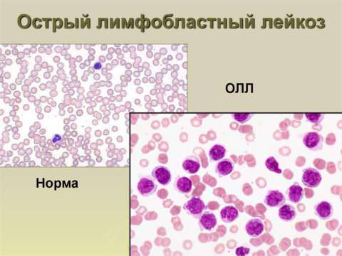 Острый лимфобластный лейкоз у детей