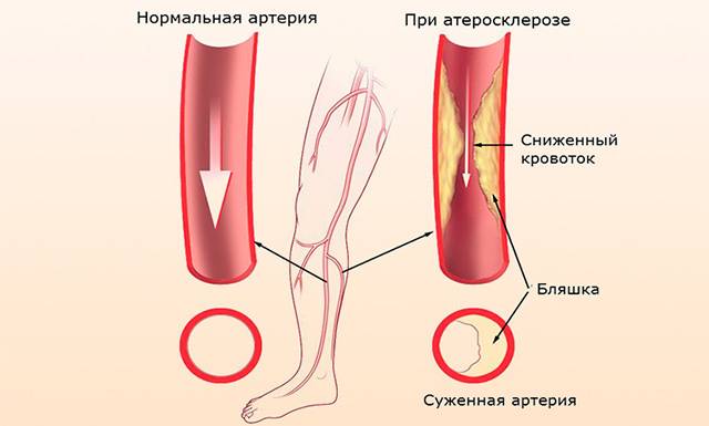 Атеросклероз ног