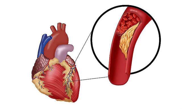Холестериновая бляшка в сосудах сердца