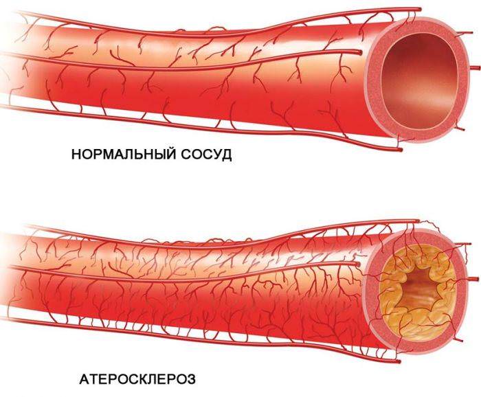 Атеросклероз сосуда