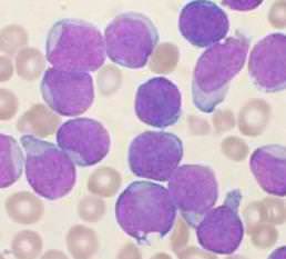 лимфоциты в крови понижены