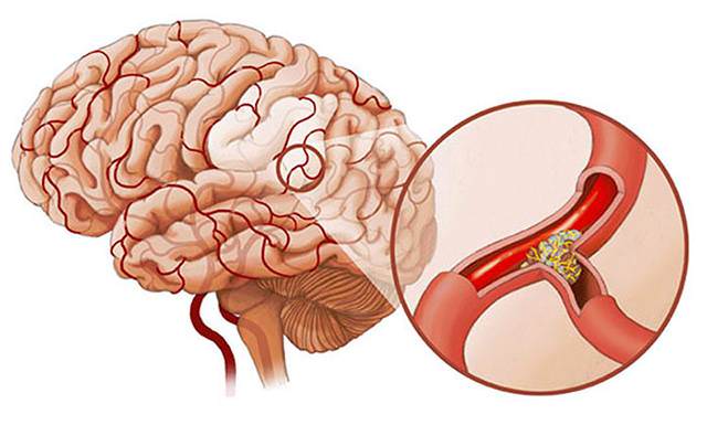 Холестериновые бляшки в сосудах головного мозга