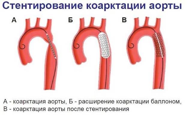 Операции на аорте