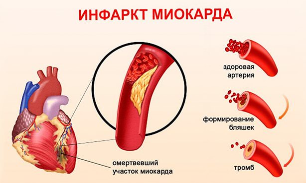 Острый инфаркт миокарда, механизм появления бляшки и тромба