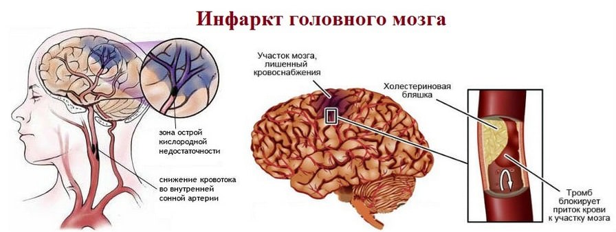 Инфаркт мозга неуточненный. Ишемический инфаркт головного мозга осложнения. Ишемический инсульт (инфаркт мозга). Инфаркт мозга вызванный тромбозом мозговых артерий. Ишемический инфаркт мозга клинические проявления.