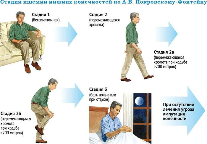 Описание, симптомы четырех стадий атеросклероза ног