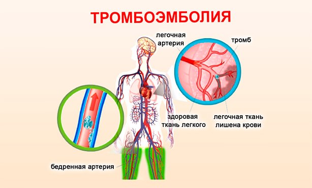 Тромбоэмболия
