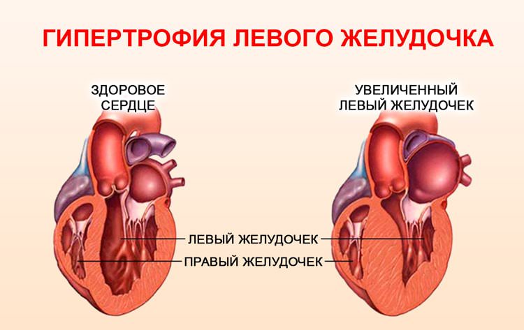 Гипертрофия левого желудочка