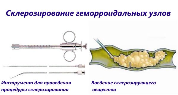 Инструмент шприц для введения склерозанта