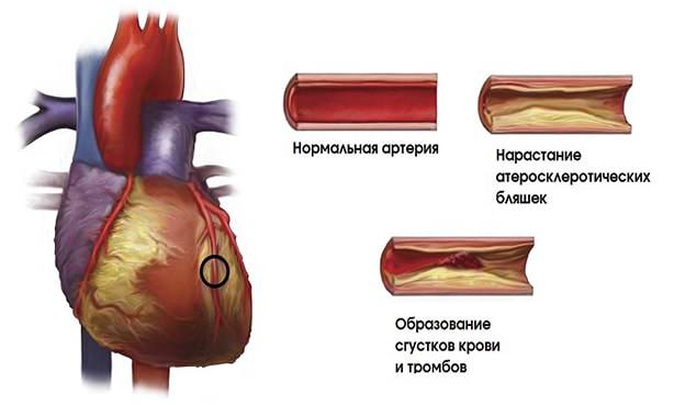 Процесс образования бляшки в коронарных артериях