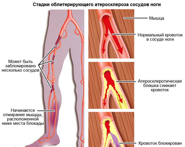 Образование атеросклеротической бляшке в сосуде ноги