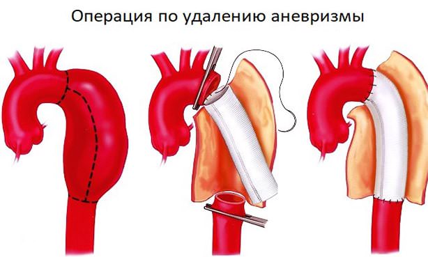 Аневризма артерии