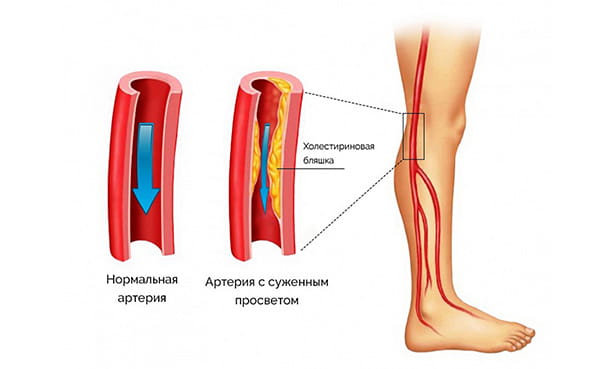 Атероматозная бляшка сужает просвет артерии в ноге