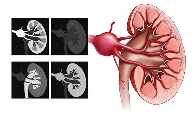Аневризма почечной артерии