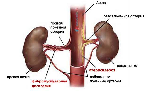 Склеротические бляшки в почечных артериях