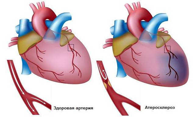 Атеросклероз сердечной артерии