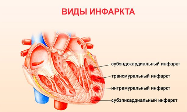 Виды инфаркта сердечной мышцы