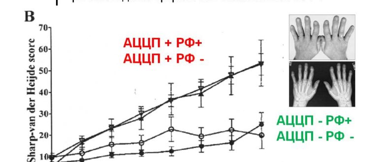 Аццп при ревматоидном артрите. АЦЦП при ревматоидном норма. Ревматоидный артрит анализ крови АЦЦП. Показатели АЦЦП при ревматоидном артрите. АЦЦП анализ крови при ревматоидном артрите.